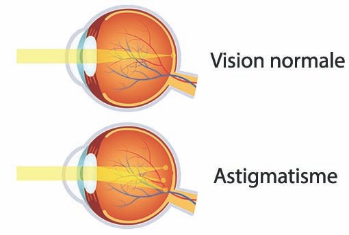 astigmatisme