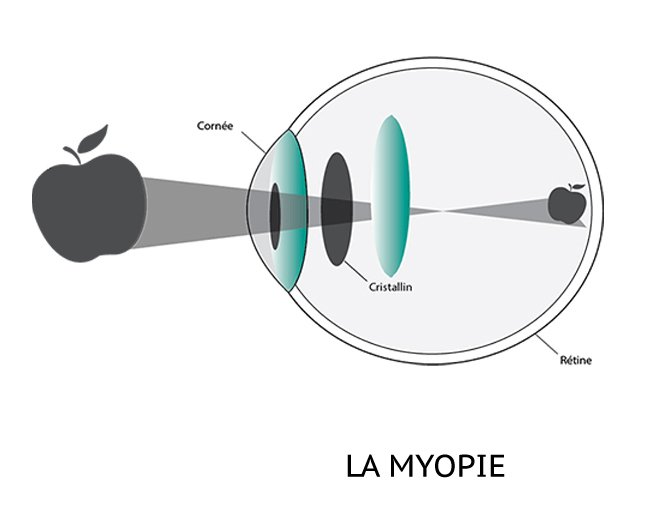 myopie